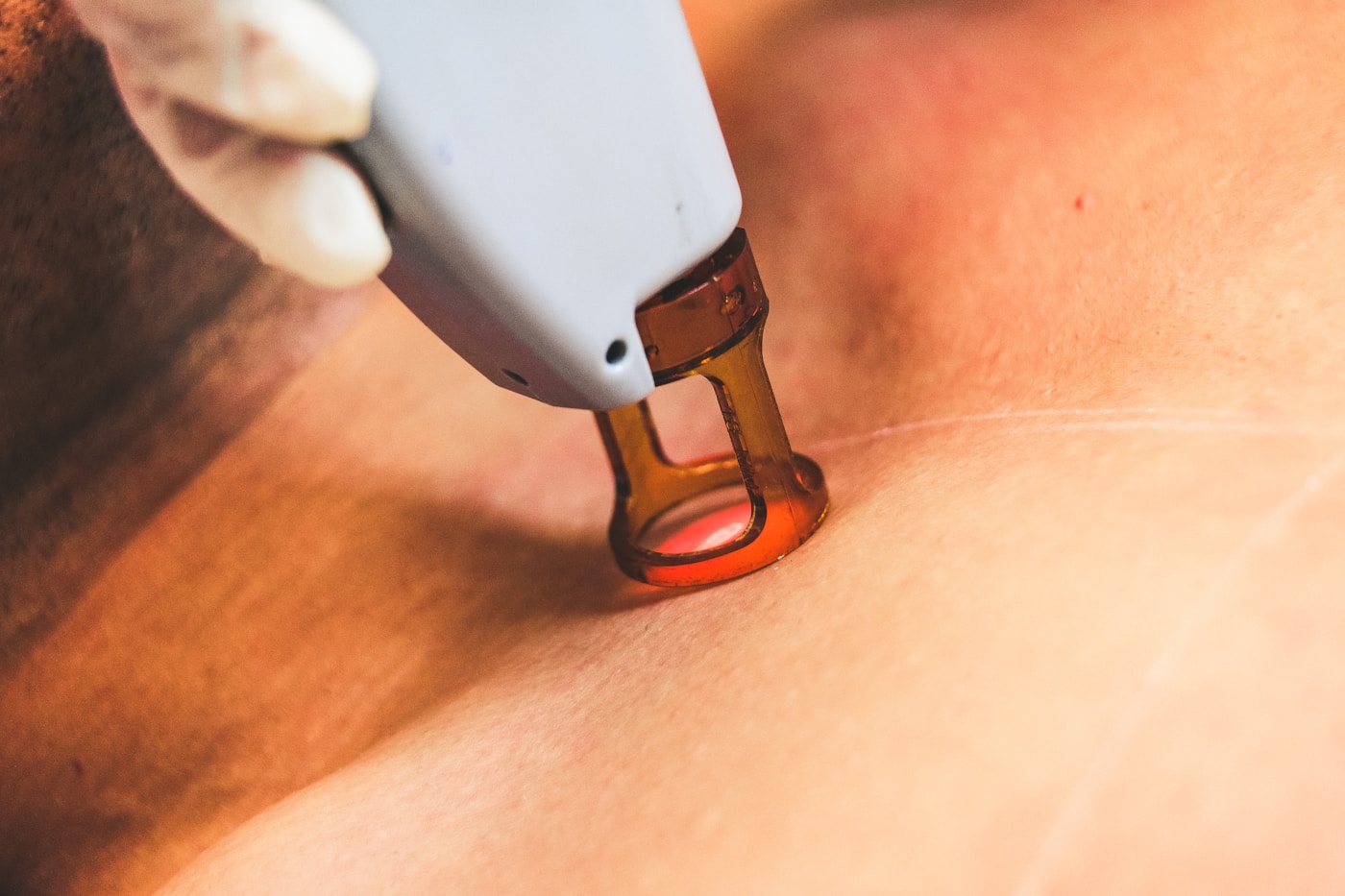 Laser Hair Removal — 416Skin Toronto